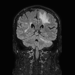 File:Brain metastases from lung cancer (Radiopaedia 83839-99028 Coronal FLAIR 51).jpg