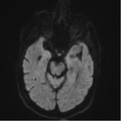 Brain metastasis (lung cancer) (Radiopaedia 48289-53179 Axial DWI 38).png