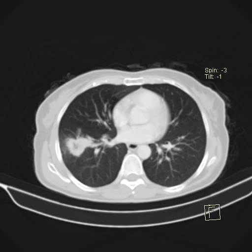Brain metastasis as initial presentation of non-small cell lung cancer (Radiopaedia 65122-74127 Axial lung window 28).jpg