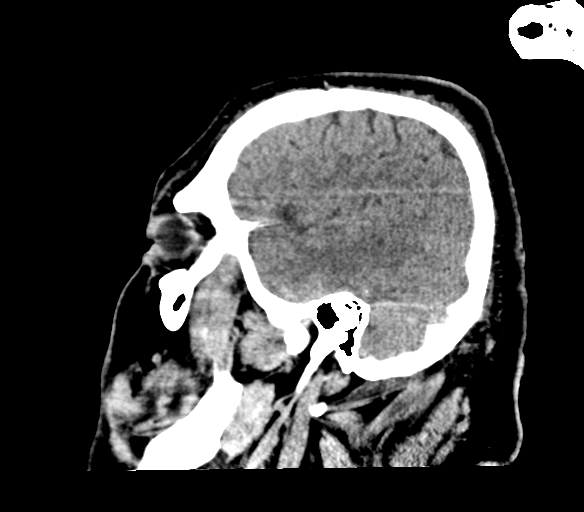 File:Brainstem hemorrhage (Radiopaedia 81294-94976 C 11).jpg