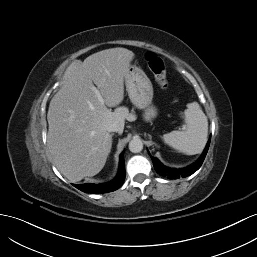 Breast carcinoma with pathological hip fracture (Radiopaedia 60314-67974 B 15).jpg