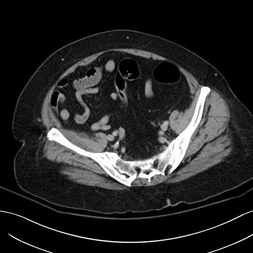 Breast carcinoma with pathological hip fracture (Radiopaedia 60314-67974 B 55).jpg