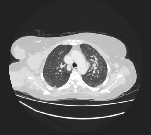 Breast metastases from facial malignant melanoma (Radiopaedia 60316-67975 Axial lung window 29).jpg