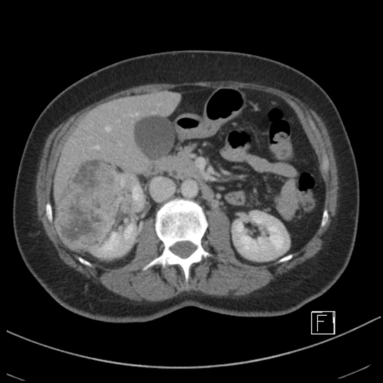 File:Breast metastases from renal cell cancer (Radiopaedia 79220-92225 C 40).jpg