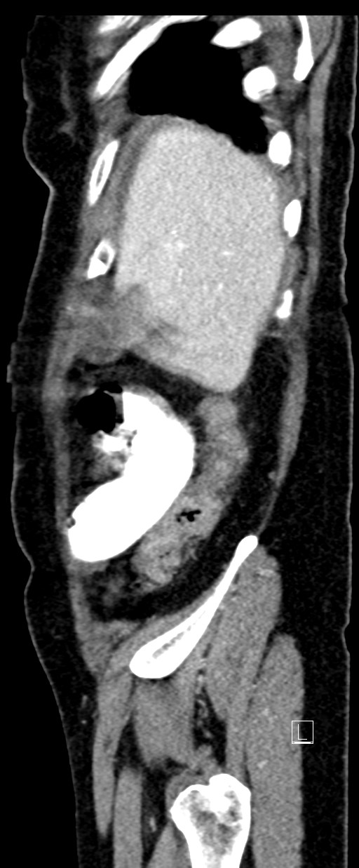 Broad ligament hernia (Radiopaedia 84802-100276 C 74).jpg