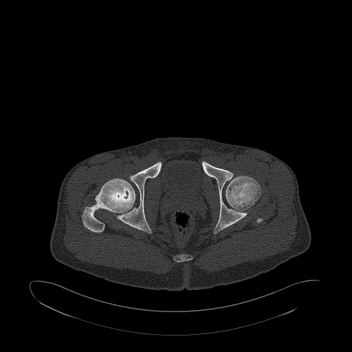 Brodie abscess- femoral neck (Radiopaedia 53862-59966 Axial bone window 156).jpg