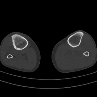 Brodie abscess - tibia (Radiopaedia 66028-75204 Axial bone window 21).jpg