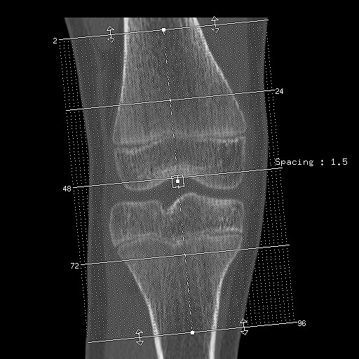 Brodie abscess of the tibia (Radiopaedia 58984-66250 Axial bone window 1).jpg