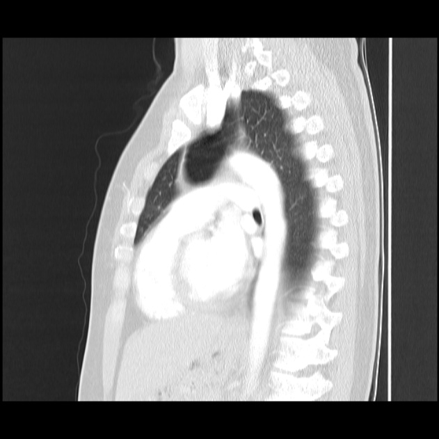 Bronchial atresia (Radiopaedia 22965-22992 Sagittal lung window 24).jpg