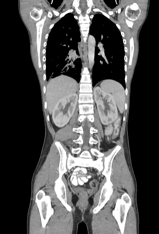 Bronchial carcinoid tumor (Radiopaedia 57187-64090 B 81).jpg