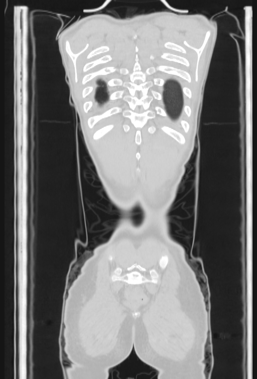 Bronchial carcinoid tumor (Radiopaedia 57187-64090 Coronal lung window 104).jpg