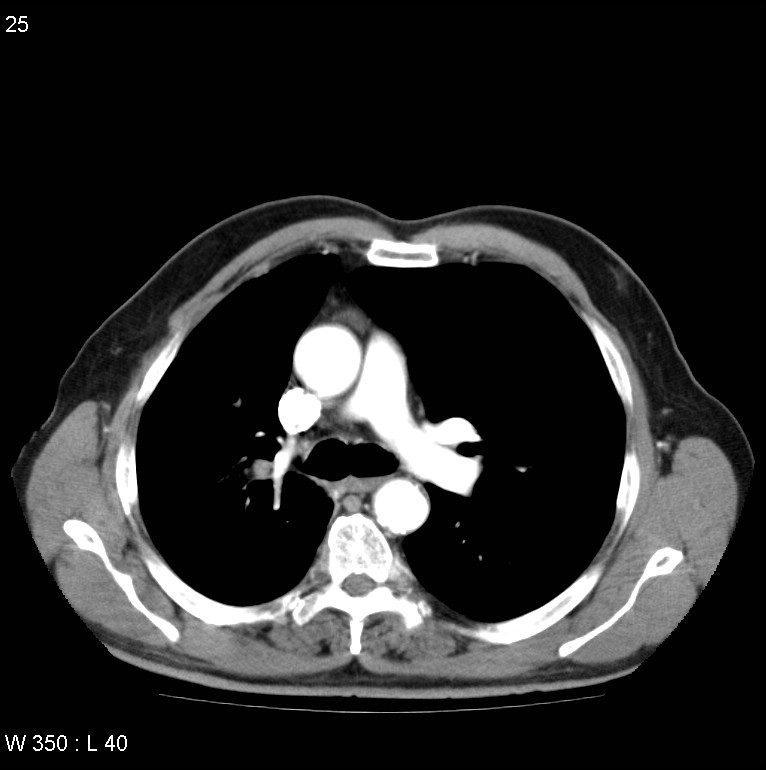 Bronchial carcinoid tumor with right lower lobe collapse (Radiopaedia 29060-29422 A 24).jpg
