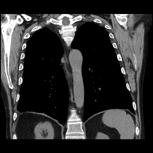 File:Bronchial stenosis - lung transplant (Radiopaedia 73133-83848 Coronal non-contrast 44).jpg