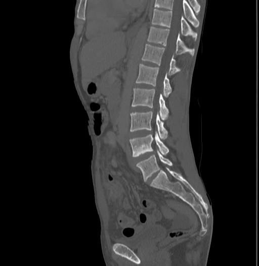 Bronchiectasis in Crohn disease (Radiopaedia 60311-67977 Sagittal bone window 133).jpg