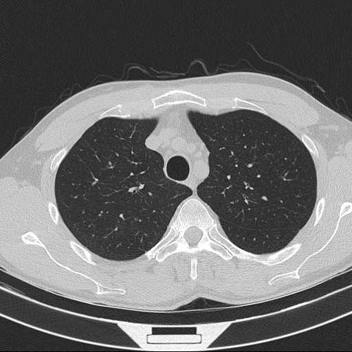 File:Bronchocele (Radiopaedia 60676-68429 Axial lung window 17).jpg