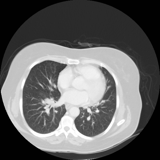 Bronchogenic carcinoma (Radiopaedia 73497-84262 Axial lung window 40).jpg