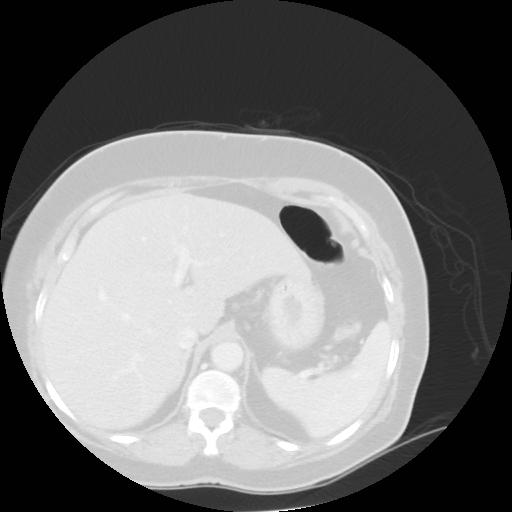 Bronchogenic carcinoma (Radiopaedia 73497-84262 Axial lung window 58).jpg