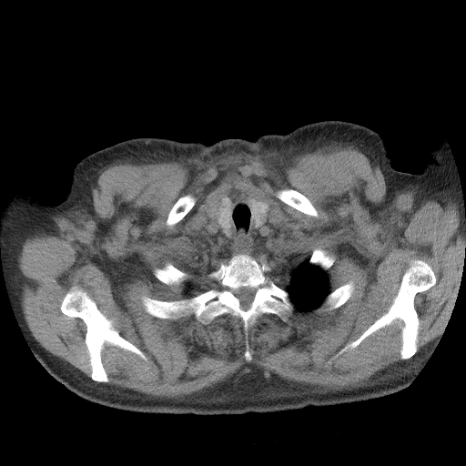 Bronchogenic carcinoma with metastatic lymphadenopathy (Radiopaedia 37671-39569 Axial non-contrast 5).jpg