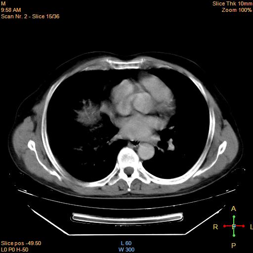 File:Bronchogenic carcinoma with superior vena caval invasion (Radiopaedia 22378-22406 Axial liver window 13).jpg