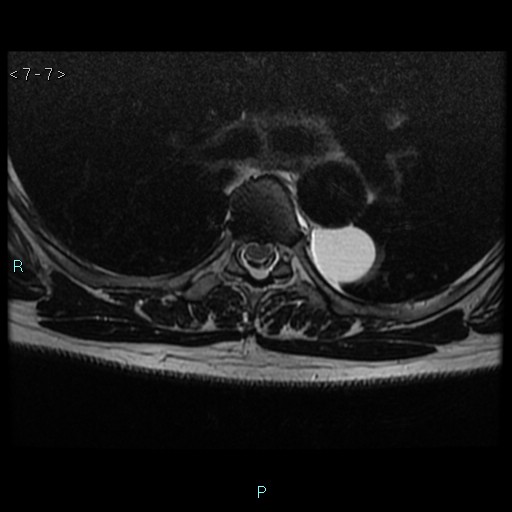 File:Bronchogenic cyst - posterior mediastinal (Radiopaedia 43885-47365 Axial T2 7).jpg