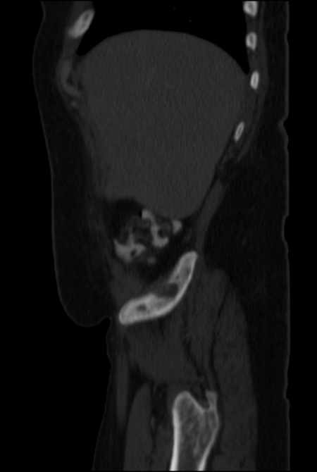 Brown tumors compressing the spinal cord (Radiopaedia 68442-77988 H 11).jpg