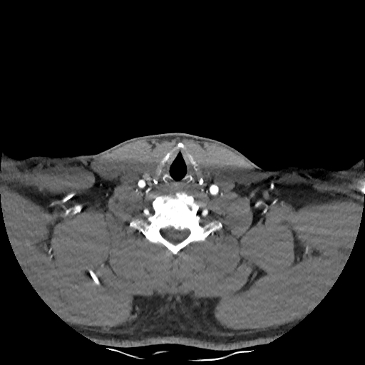 Buccal fat pad arteriovenous malformation (Radiopaedia 70936-81144 D 83).jpg