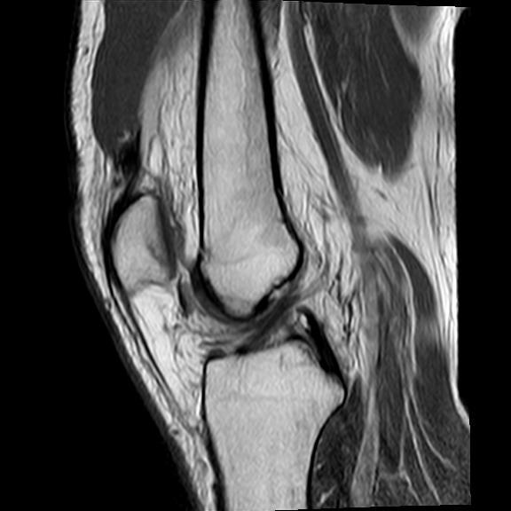 File:Bucket handle tear - medial meniscus (Radiopaedia 29250-29664 Sagittal PD 11).jpg