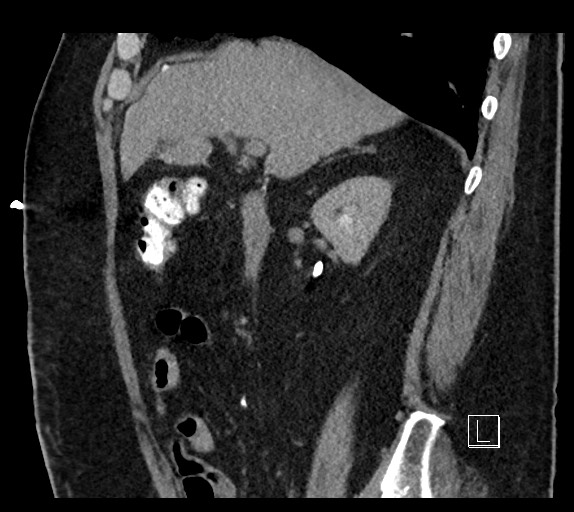 Buried bumper syndrome - gastrostomy tube (Radiopaedia 63843-72577 Sagittal Inject 81).jpg