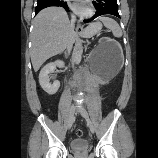 Burned-out testicular seminoma - retroperitoneal nodal metastases (Radiopaedia 62872-71245 B 39).jpg