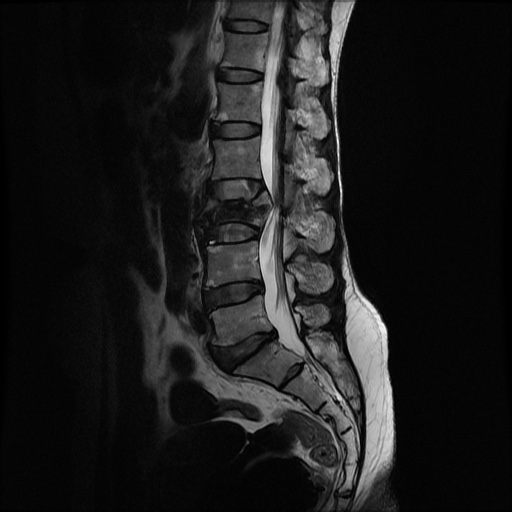 File:Burst fracture - lumbar spine (Radiopaedia 72877-83541 Sagittal T2 6).jpg