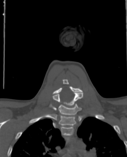 Butterfly vertebra (Radiopaedia 77903-90209 Coronal bone window 47).jpg