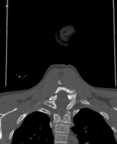 Butterfly vertebra (Radiopaedia 77903-90209 Coronal bone window 70).jpg