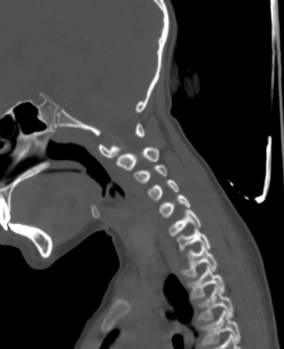 Butterfly vertebra (Radiopaedia 77903-90209 Sagittal bone window 27).jpg