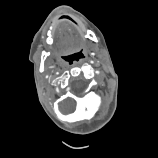 C2 fracture with vertebral artery dissection (Radiopaedia 37378-39200 A 174).png
