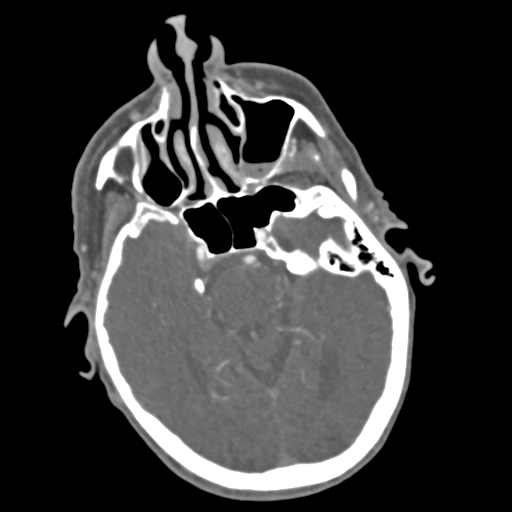 C2 fracture with vertebral artery dissection (Radiopaedia 37378-39200 A 223).png