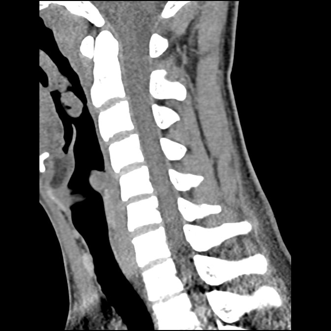 C5 facet fracture (Radiopaedia 58374-65499 D 38).jpg