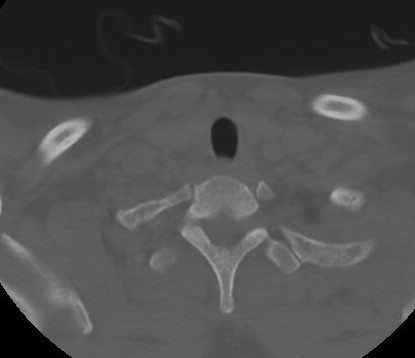 C7 laminar fracture and Klippel-Feil syndrome (Radiopaedia 86710-102850 Axial bone window 66).jpg