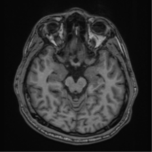 CNS vasculitis (Radiopaedia 55715-62263 Axial T1 9).png