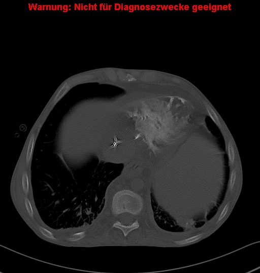 File:Calcific constrictive pericarditis (Radiopaedia 24701-24967 Axial bone window 24).jpg