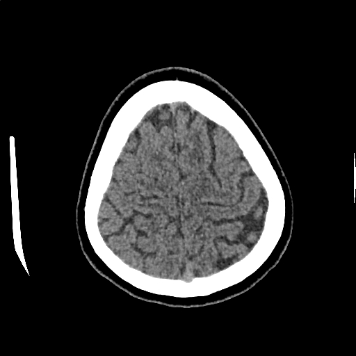 Calcified cerebral hydatid cyst (Radiopaedia 65603-74717 Axial non-contrast 68).jpg