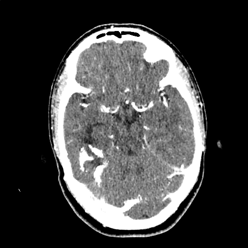 Calcified cerebral hydatid cyst (Radiopaedia 65603-74717 Axial with contrast 25).jpg
