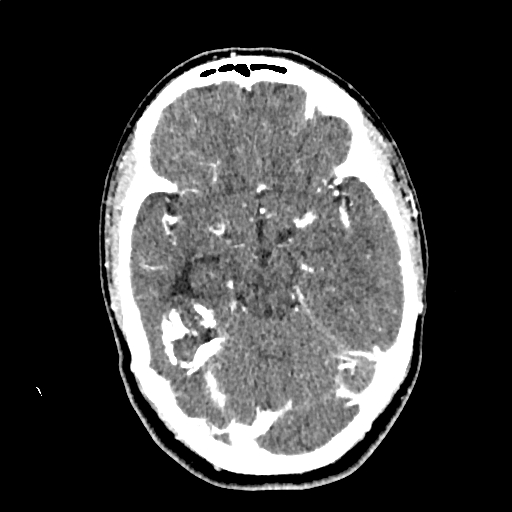 Calcified cerebral hydatid cyst (Radiopaedia 65603-74717 Axial with contrast 26).jpg