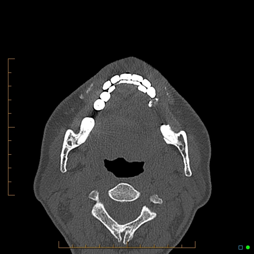 Calcified facial augmentation fillers (Radiopaedia 79514-92679 Axial bone window 113).jpg