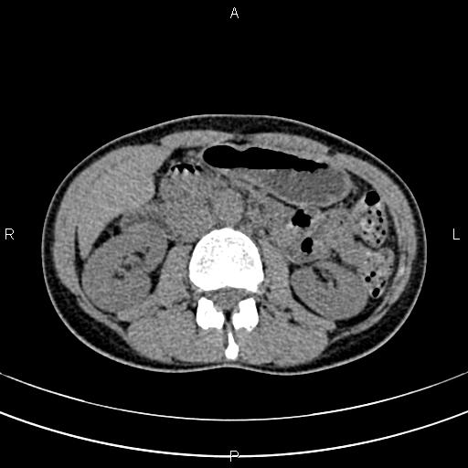 File:Calcified hepatic hydatid cyst (Radiopaedia 83870-99072 Axial non-contrast 80).jpg