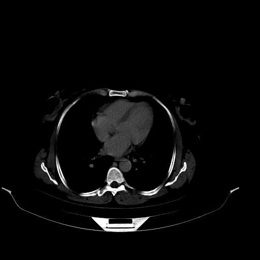 File:Calcified hydatid cyst of the liver (Radiopaedia 21212-21112 Axial bone window 4).jpg