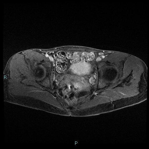 File:Canal of Nuck cyst (Radiopaedia 55074-61448 Axial T1 C+ fat sat 36).jpg