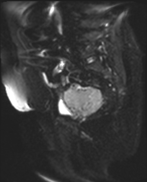 Cancer cervix - stage IIb (Radiopaedia 75411-86615 Sagittal DWI 15).jpg