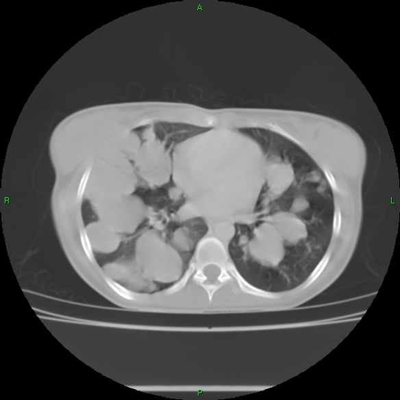 File:Cannon ball metastases - synovial sarcoma (Radiopaedia 26135-26271 Axial lung window 21).jpg