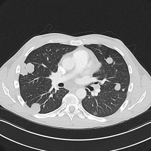 File:Cannonball metastases - testicular choriocarcinoma (Radiopaedia 84510-99891 Axial lung window 49).jpg