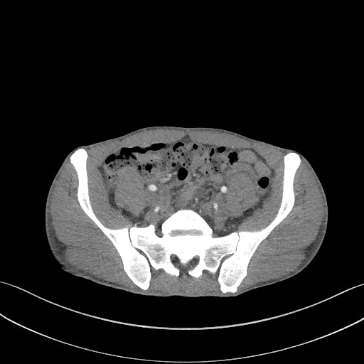 Cannonball metastases - testicular choriocarcinoma (Radiopaedia 84510-99891 B 165).jpg